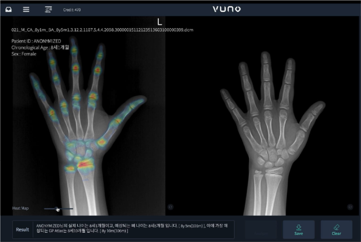 소아성장검사 방법